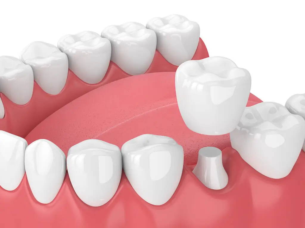 Same-Day Dental Crowns In Silver Spring, MD: Fast, Strong Protection For Damaged Teeth