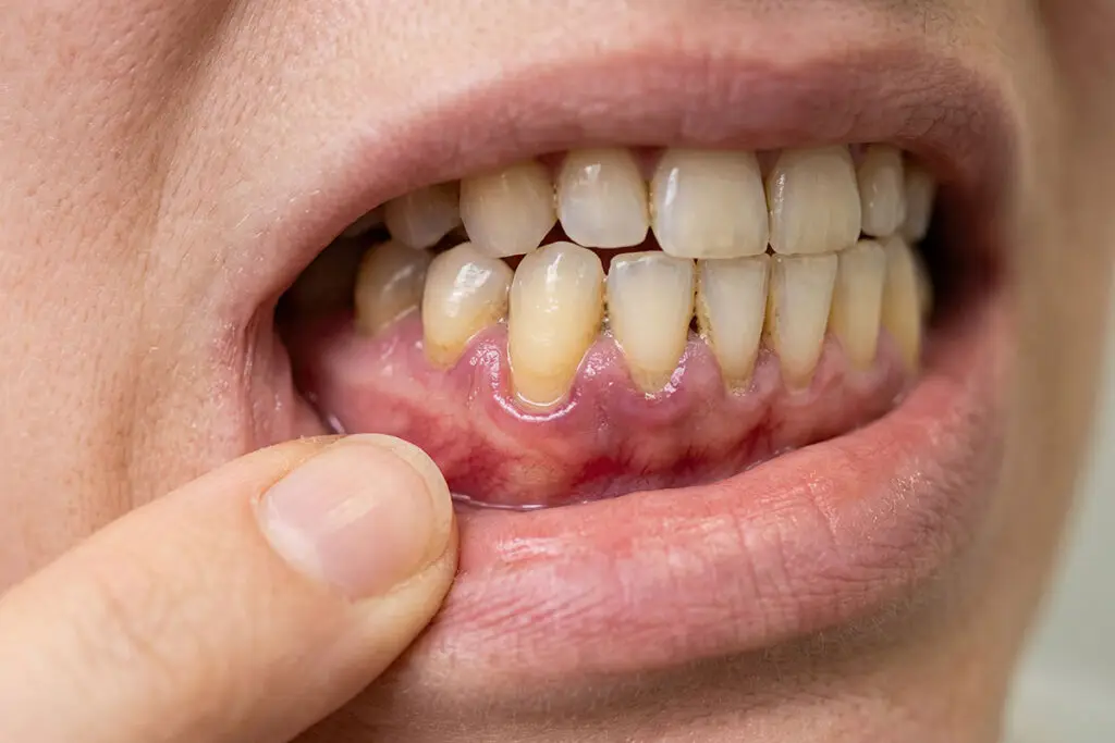 Periodontal Care In Silver Spring, MD: Healthier Gums, Stronger Teeth, Better Long-Term Oral Health